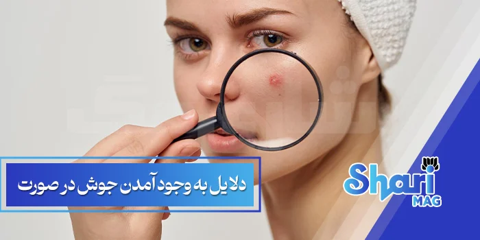 دلایل-به-وجود-آمدن-جوش-در-صورت